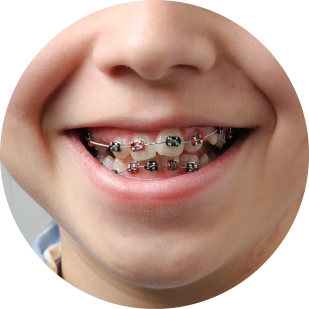 Imagen Brackets tradicionales